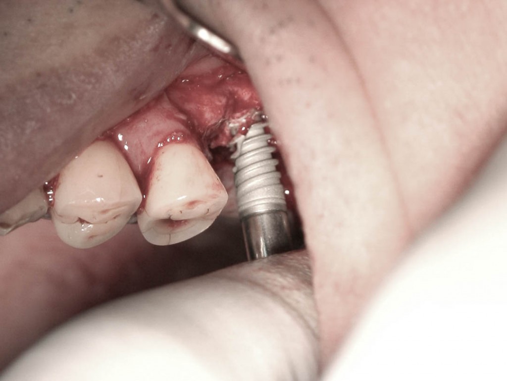 Implant-4-015